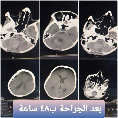  ناجحة باستخدام المجهر في مشفى حماه الوطني