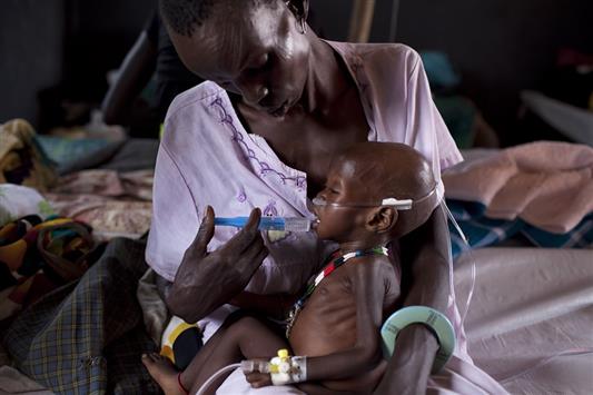 طفل يعاني من سوء تغذية حاد في مخيم طبي تديره منظمة "اطباء بلا حدود" جنوب السودان (أ ف ب)